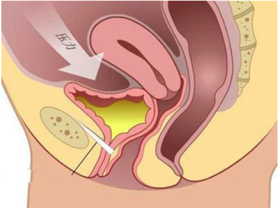 Làm thế nào hiệu quả là thanh co ngót âm đạo? Nguyên tắc của thanh co ngót âm đạo là gì?