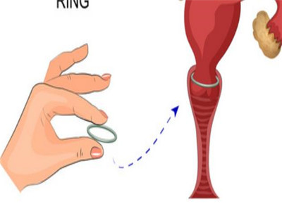 Vòng kiểm soát sinh sản là gì? Các loại vòng tránh thai là gì?