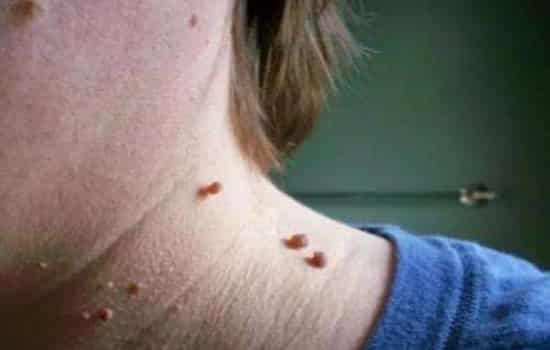 Phải làm gì nếu mụn cóc trên cổ? Điều gì xảy ra với mụn cóc trên cổ